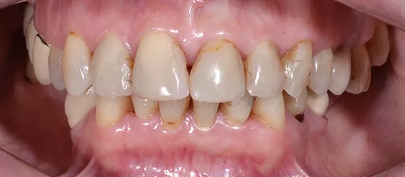 Лечение кариеса, художественная реставрация зубов до