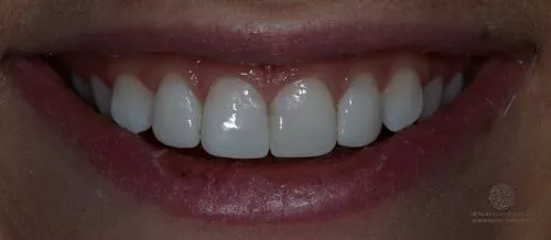 Отбеливание ZOOM4, художественная реставрация зубов после