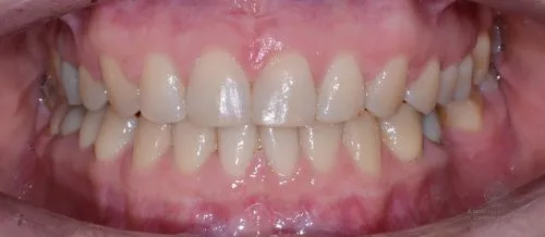 Коррекция прикуса и положения зубов после
