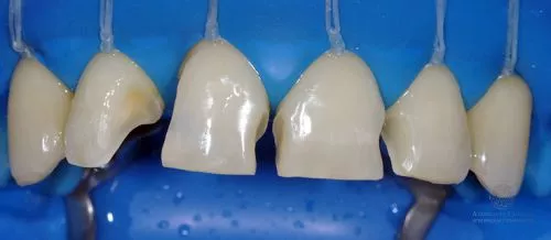 Художественная реставрация зубов до