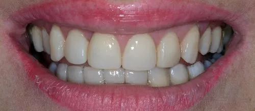 Художественная реставрация зубов после