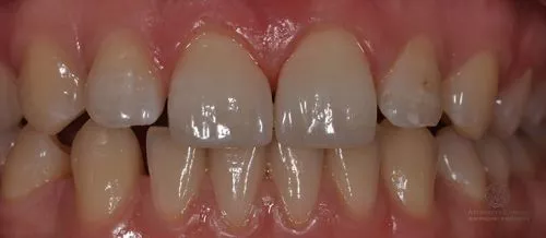 Художественная реставрация зубов после