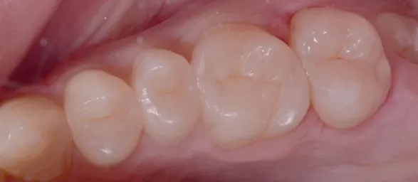 Лечение кариеса, художественная реставрация зубов после