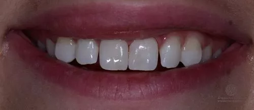 Отбеливание ZOOM4, художественная реставрация зубов до