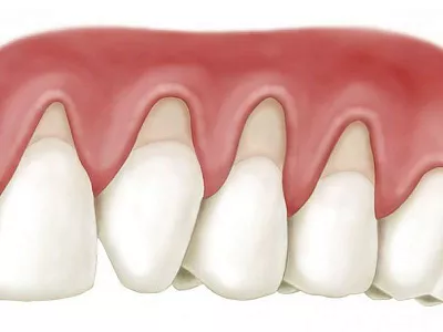 Удлинение клинической коронковой части зуба