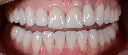 Удлинение зубов