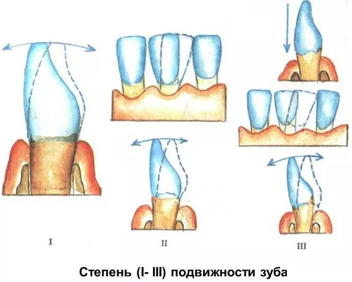 Патологическая подвижность зубов: степени, лечение подвижности зубов