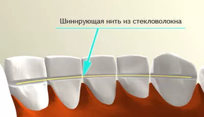 Подвижность зубов, лечение подвижности зубов